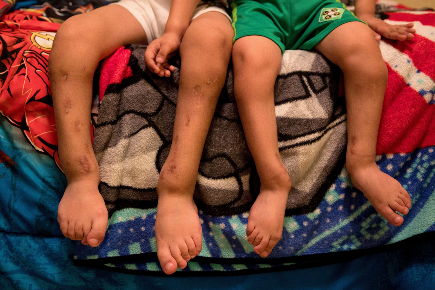 As the boys grow they have to undergo numerous surgeries to correct the bends in their bones so that they are able to walk.