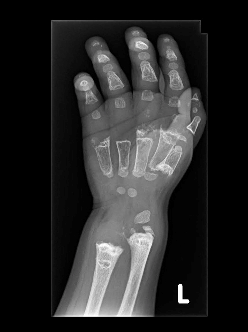 An X-ray shows Arshaan's hand bones